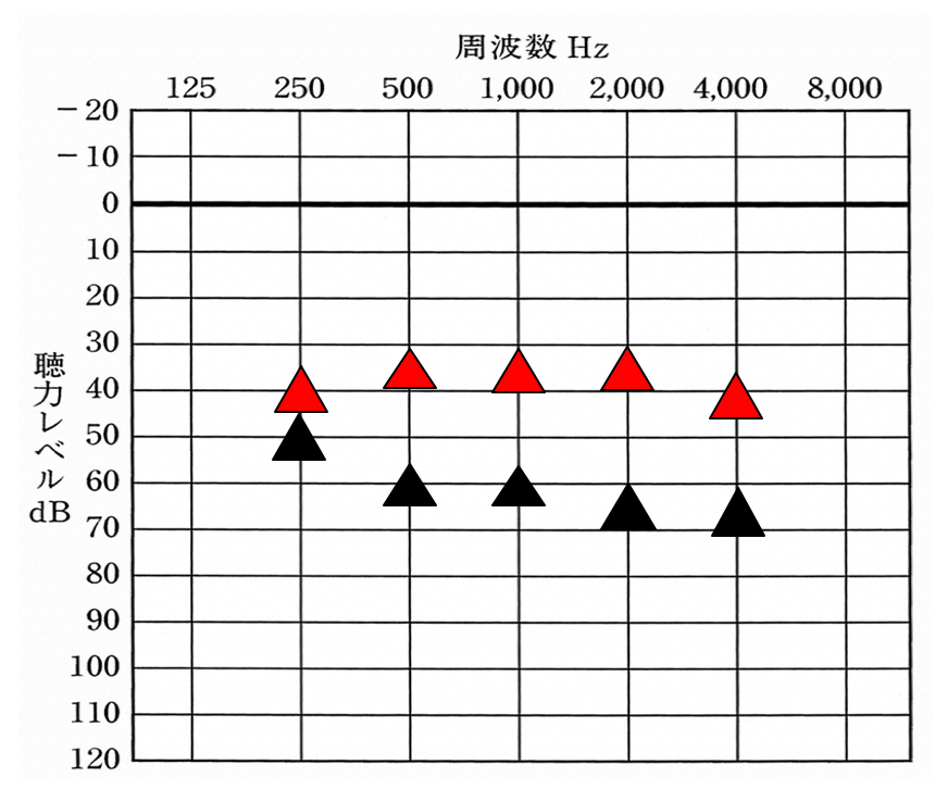 聴力ベースで見た補聴器の改善に関しては、この通り。本来は、30~40dBくらいまで改善させないと聞きにくさを感じやすくなってしまうのだが、残念ながら聴力低下が大きすぎるとそこまで改善させることが困難になる。そのため、このようなケースは、特に補聴器の効果はないと言われやすい