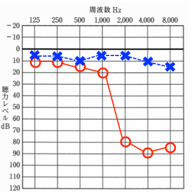 クロス補聴器が合う聴力その③。補聴器では、効果が出にくい聴力だった場合、片耳が正常であれば、クロスで補った方が、聞こえは改善できる
