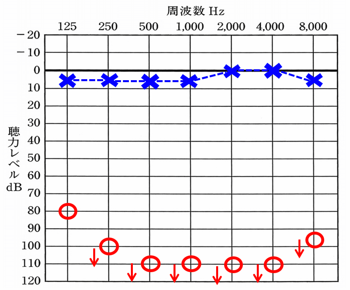 実際のお客様の聴力。右耳は、日常生活上、ほとんど何も聞こえない耳になる。