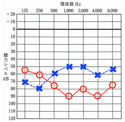左右の聴力が別々のタイプ