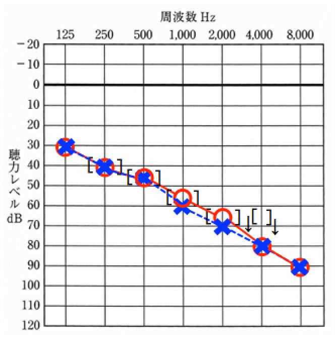 老人性難聴のオージオグラム例。高い音が低い音より聞こえにくくなる傾向がある
