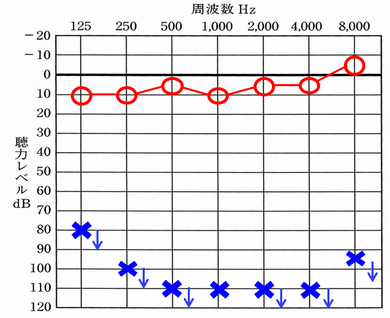 こちらの方も左側が聞こえない。この聴力は、ほとんどどころか何も聞こえない状態となる。
