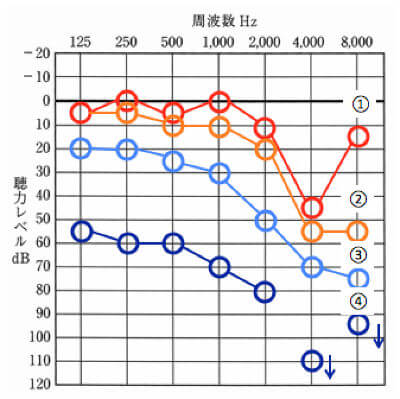 騒音性難聴の聴力低下傾向