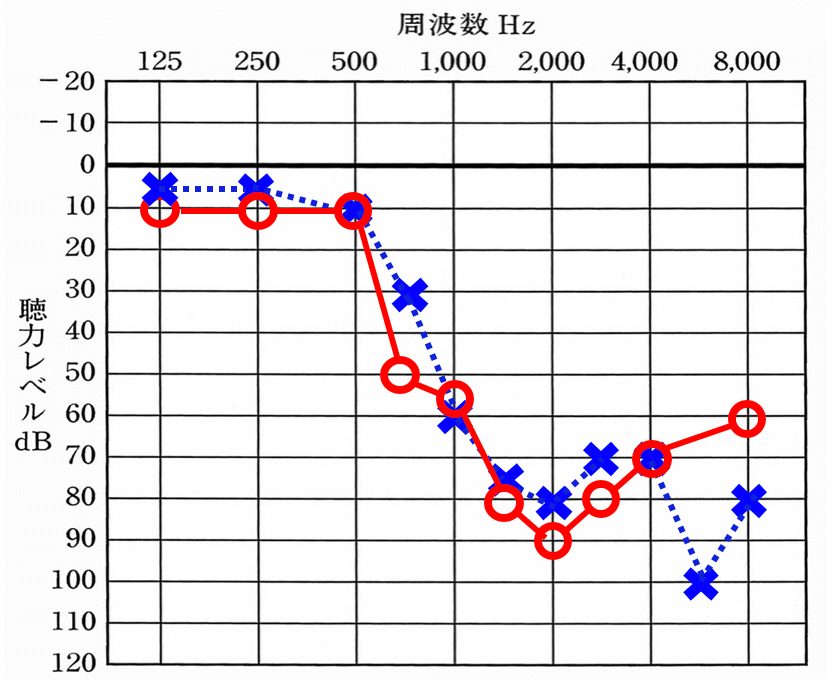 お客様の実際の聴力。中音域から急激に下がる聴力で、改善が難しい例の一つ。