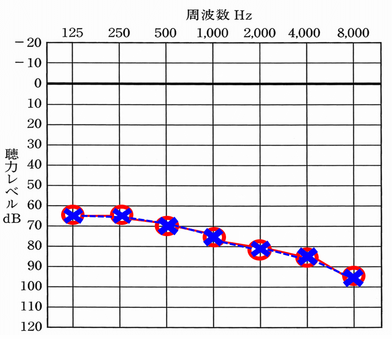高度難聴の例。