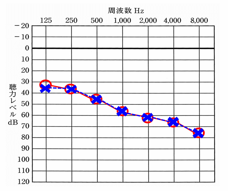両耳とも聞こえにくいケースの例。両耳とも聞こえにくい場合は、両方とも同じくらい聞こえにくいケースが多い