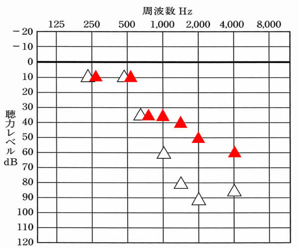 補聴器で改善を目指す数値は、△の赤いもの。白い△は、補聴器を装用していない時の聞こえ。