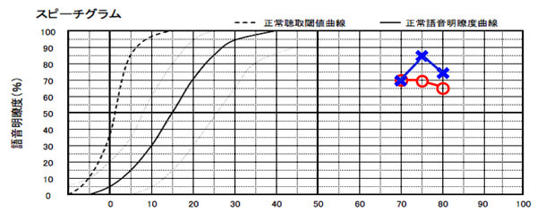 幸い、音声に関する理解力は、ある。そのため、両耳に補聴器を装用し、なるべく聞きにくくならないよう、できる限り、補うこととなる。