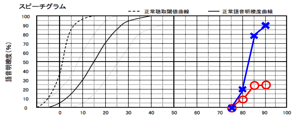 仮に同じ聴力でも明瞭度が片側悪い場合は、悪い側に補聴器を装用してもうまく改善はできない。その場合は、バイクロスを使う。たまにこのようなケースを見る。