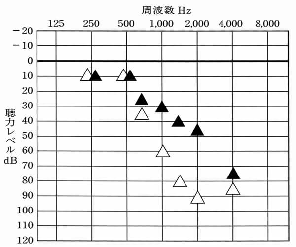 最終的な聞こえ。ほとんど目標値及びそれ以上にできたが、一部だけ足りない状態。それなりに改善ができた。なお、この数値は、耳かけより、耳あな型の方がよくなる傾向がある。