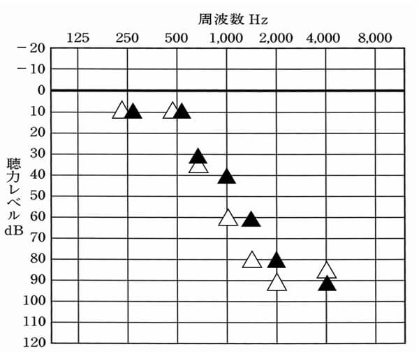 はじめに補聴器を装用し、改善させた例。お店で試聴する限り、聞きやすくなっているとのことだったので、このまま貸出。様子を見ることとなる。