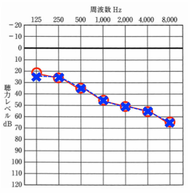 軽度難聴の方の聴力。このような低い音が聞こえ、高い音が聞こえにくくなっているケースが多い
