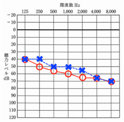 聴力が記載されている図をオージオグラムと言います