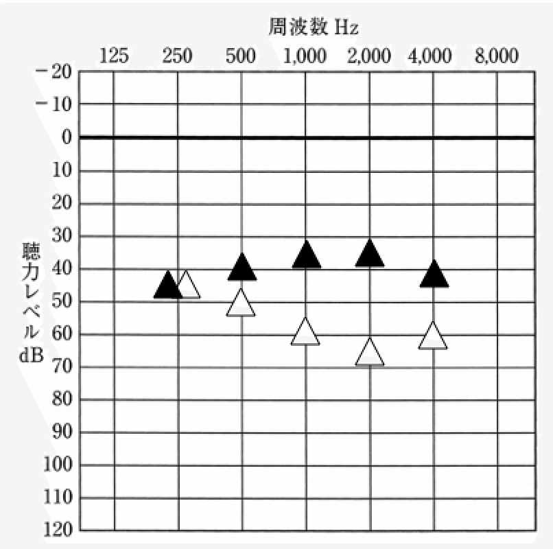 補聴器を装用した状態の音の聞こえ、なしよりも音が聞こえやすくなっている