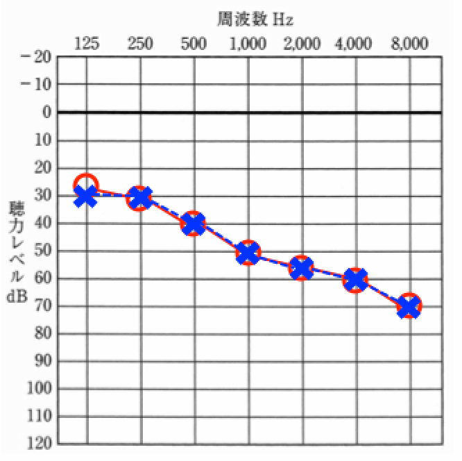 老人性難聴に見られる傾向としては、低い音が聞こえやすく、高い音が聞こえにくい状態