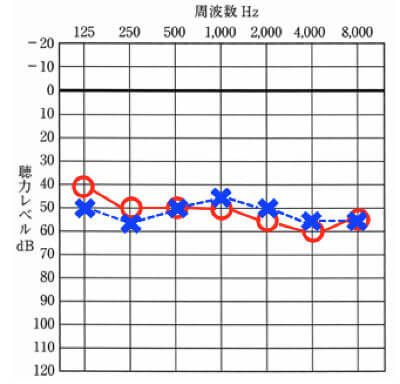 両耳装用が合う聴力の特徴は、同じような波形である事