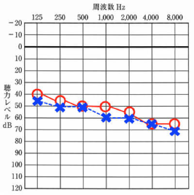両耳装用が合う聴力