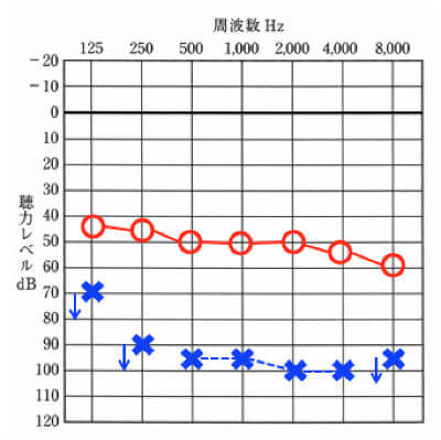 左右の聴力が似た波形を持つタイプ