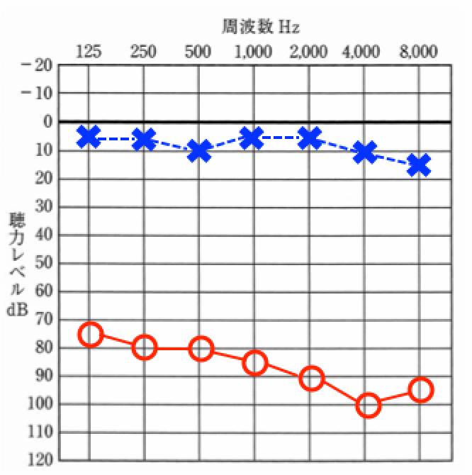 クロス補聴器が合う聴力。基本的には、補聴器を装用しても効果がない耳である事。片耳が聞こえている事。この二つが当てはまれば合う