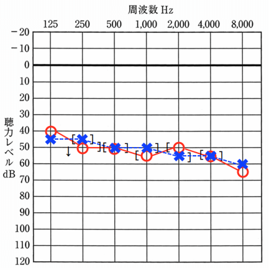 オージオメーターで計った聴力を記入するオージオグラム