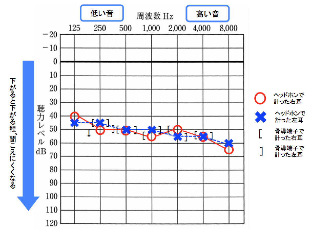 オージオグラムの数値の見方
