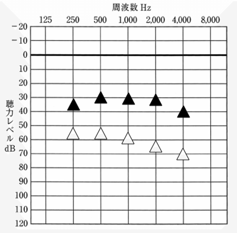主な見方は、オージオグラムと同じで、▲が補聴器を装用した状態、△が補聴器なしの状態を表す。