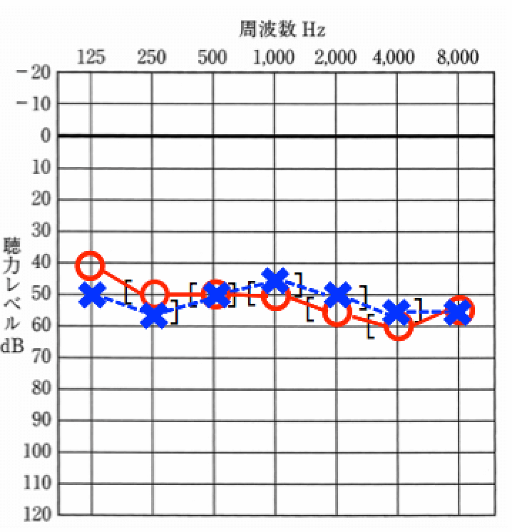両耳とも同じくらいの聞こえの方