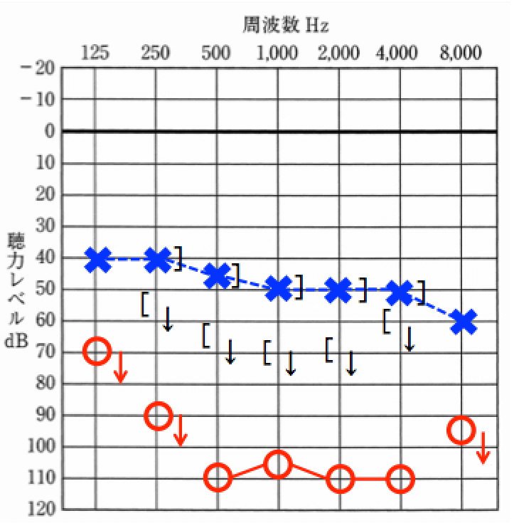 両耳の聴力に差があるケース