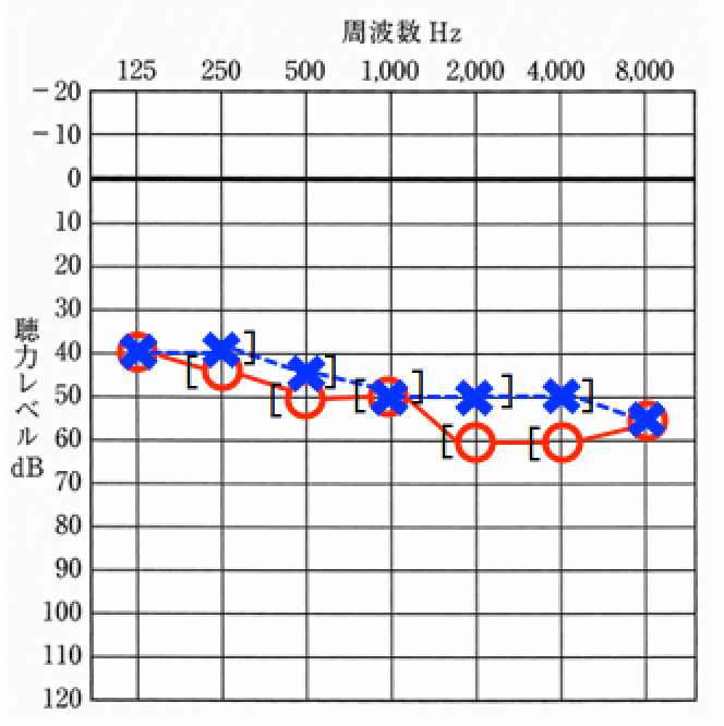 聴力測定をした結果の例。