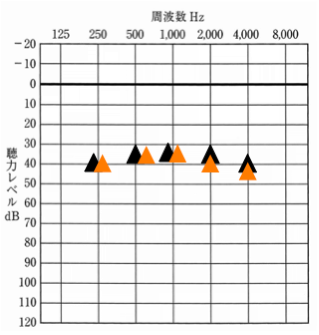 聴力例、黒が現在の聞こえ、オレンジが過去の聞こえと仮定