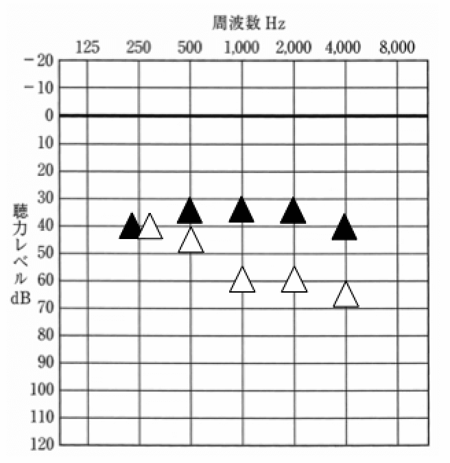 audio-onjou-01測定例、▲が補聴器装用時、△が補聴器なし。補聴器装用時の数値である程度効果がわかる