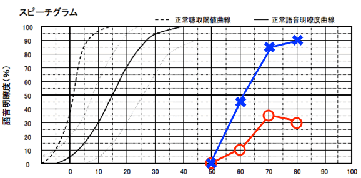 両耳の聴力が同じでも稀に明瞭度が極端に低下しているケースがある。この場合は、バイクロスが良い