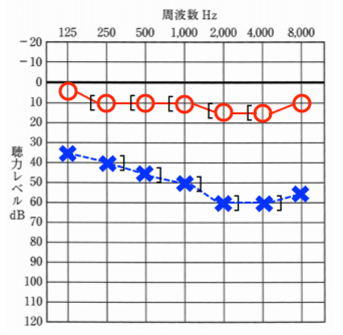片耳のみ中等度難聴の場合、悩むケースが多いが、片耳に補聴器を装用するケースが多いように感じる