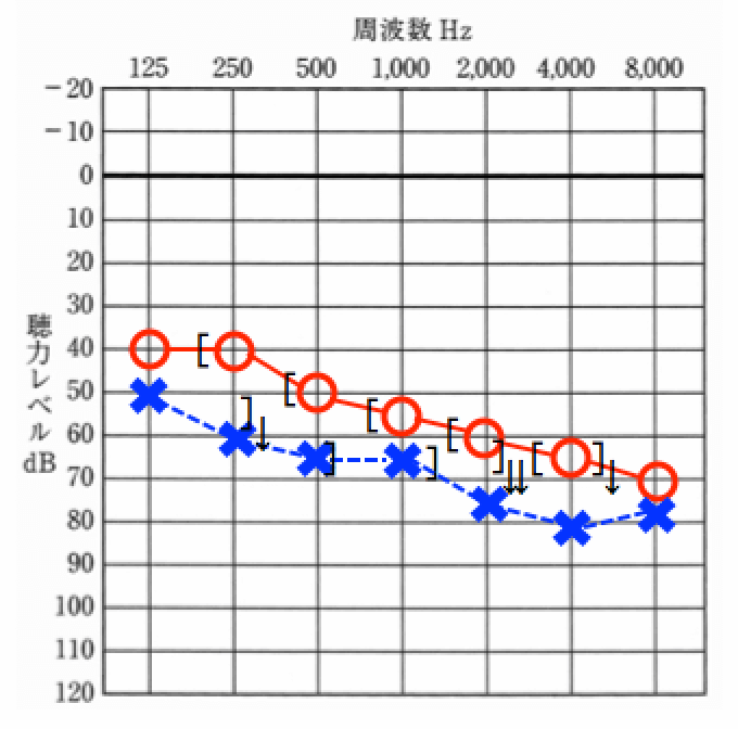聴力、明瞭度とも近い、あるいは、良い事が条件だが、この場合は、両耳装用が良い