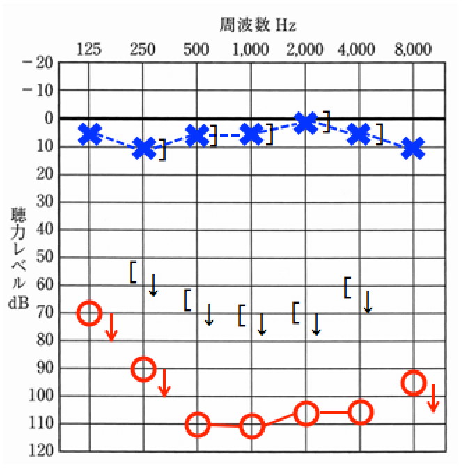 片耳のみ重度難聴の場合は、クロス補聴器が有効。それ以外では、補う事はほぼできない。