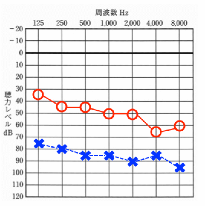 主に、幼い頃、中耳炎になり、その後、年齢によって聞こえが低下するケースに当てはまる。このようなケースは、バイクロスで補うと効果的だったりする。