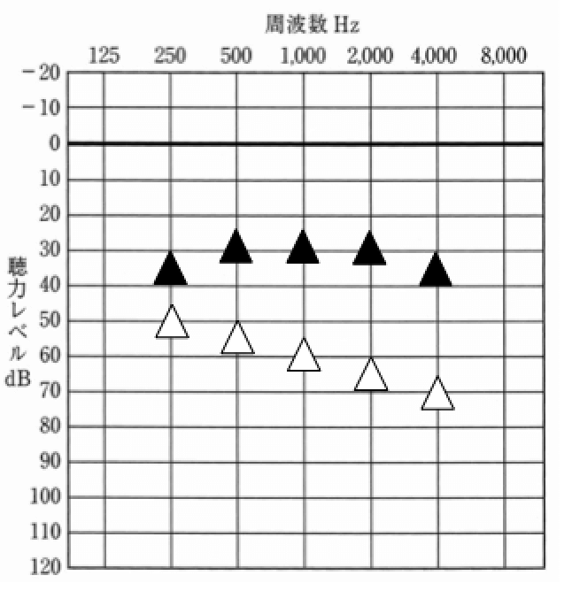 音場閾値測定とは、補聴器で聞こえを補った際、どのように補えているのかを確認する測定。耳あなの方が結果がよい傾向がある