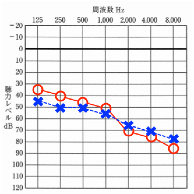 お客様の聴力、低い音よりも高い音の方が聞きにくい耳となる