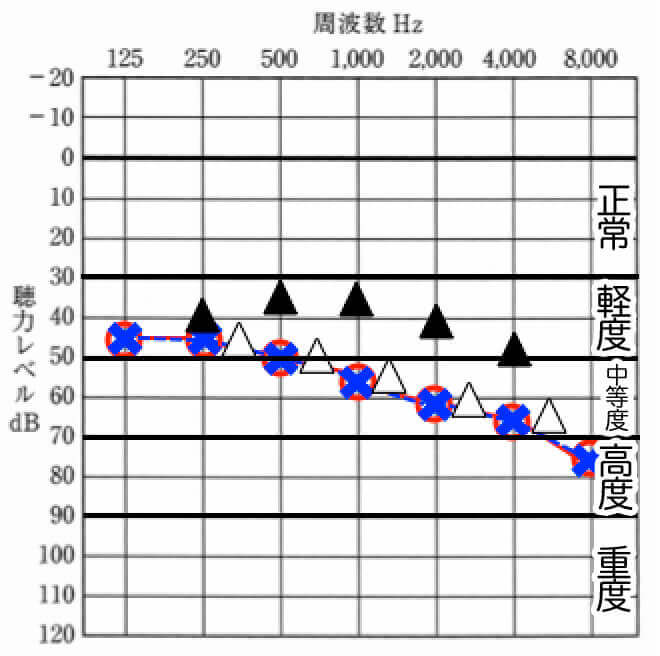 おおよその難聴度合い。こちらで見ると、少しはわかりやすくなるかも。