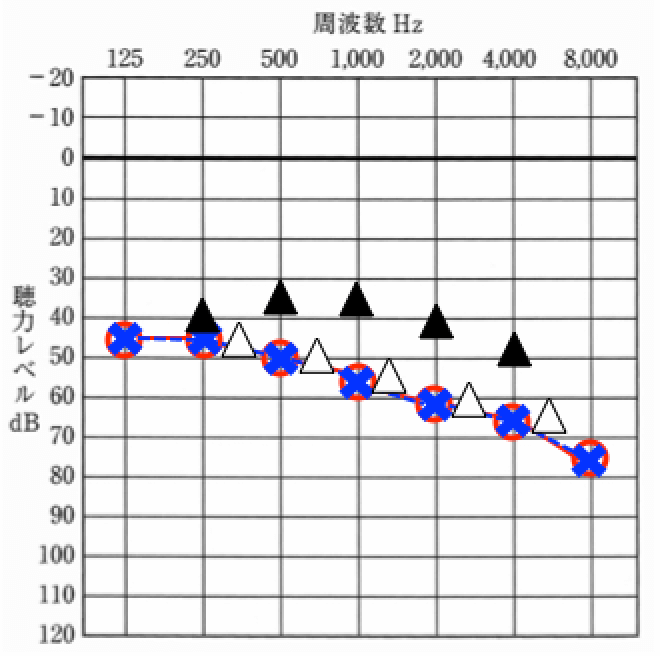 聞こえの例。この図には、聴力を検査した数値と補聴器あり、なしの数値が書かれている
