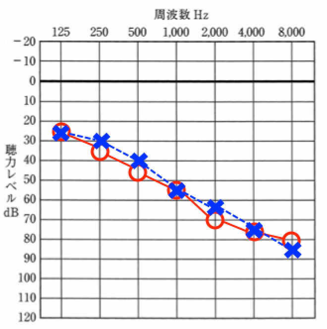 結論からいうと、このような低い音が聞こえ、高い音が聞きにくい方に見られる。