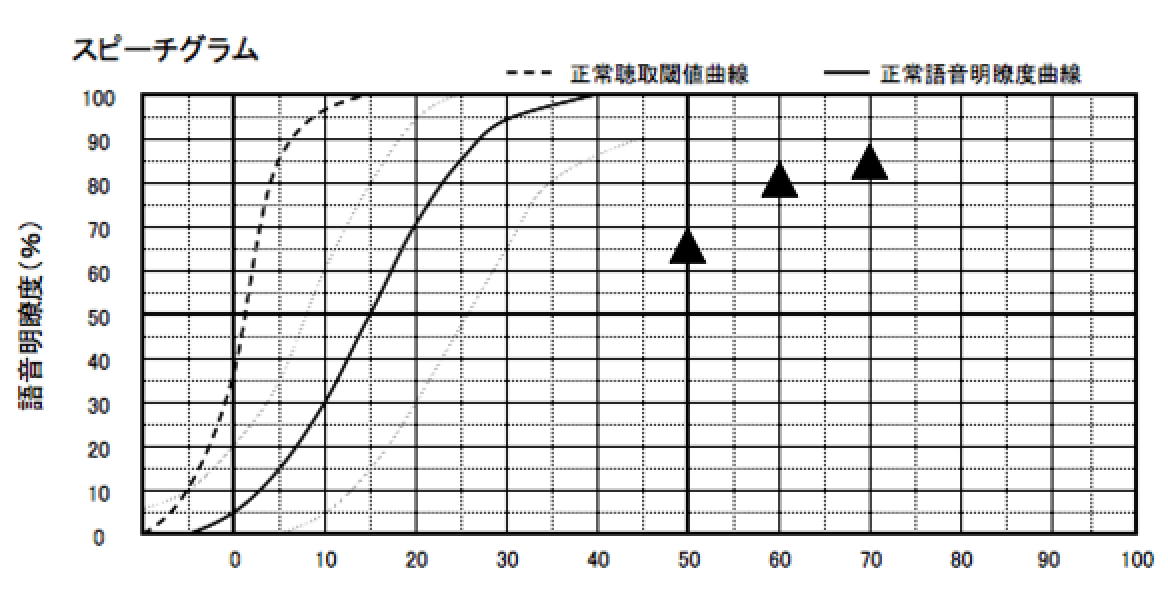 明瞭度については、このような状態。こちらを見ると、補聴器で、最も良い数値は、85%であり、耳の明瞭度より、良くなっている事がわかる。