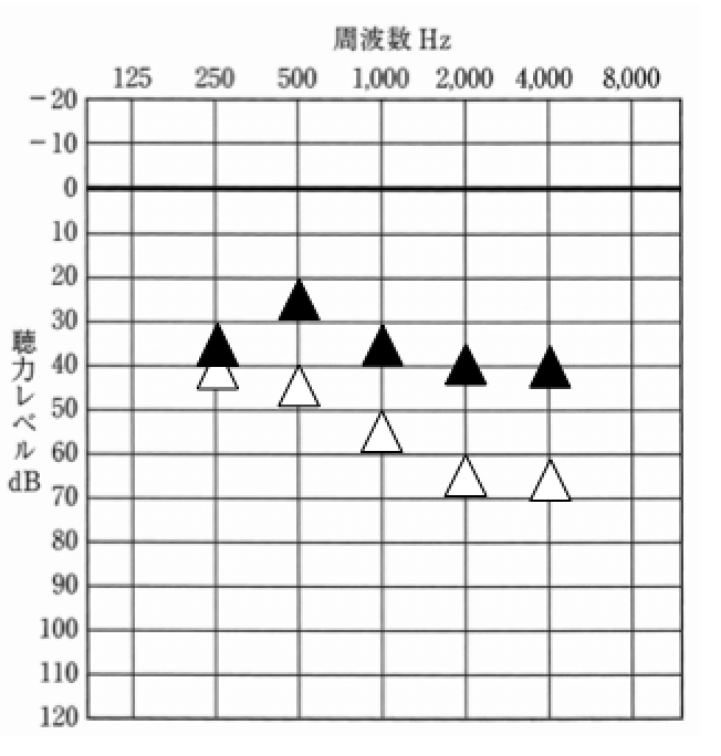 明瞭度については、このような状態。こちらを見ると、補聴器で、最も良い数値は、85%であり、耳の明瞭度より、良くなっている事がわかる。