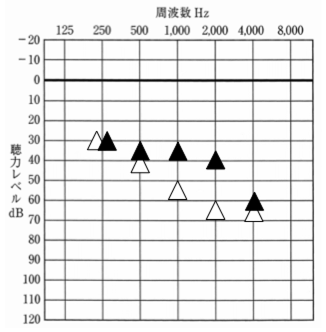 再び、RICにて調整。なお、耳あな形のデータを利用し、より良くなるよう調整。