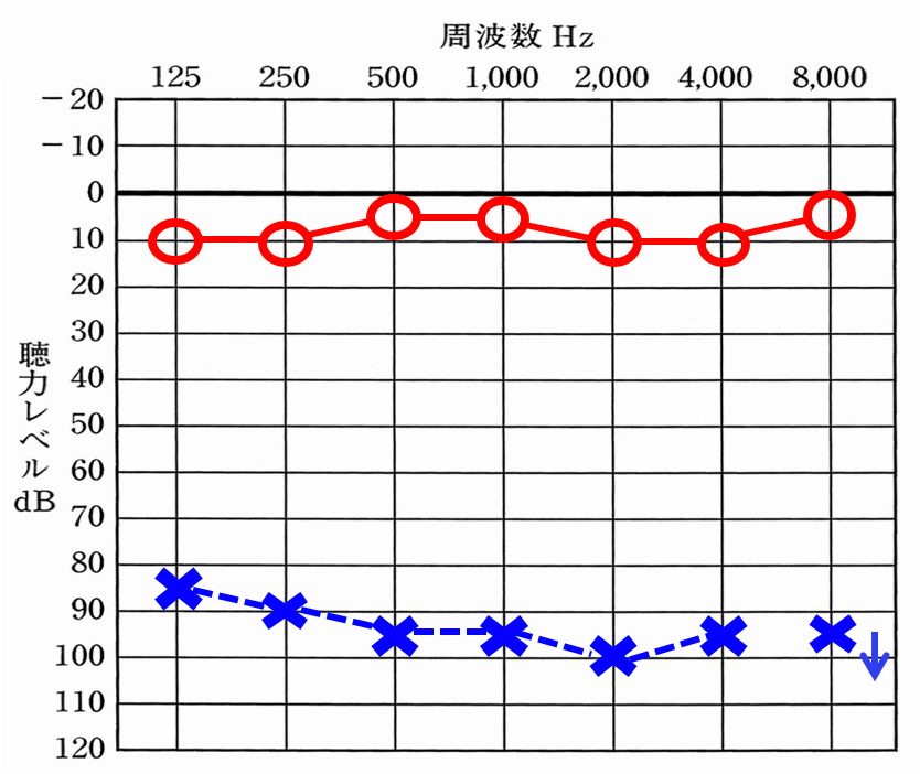 お客様の聴力、片耳が聞こえており、もう片耳は、ほとんど聞こえない状態。