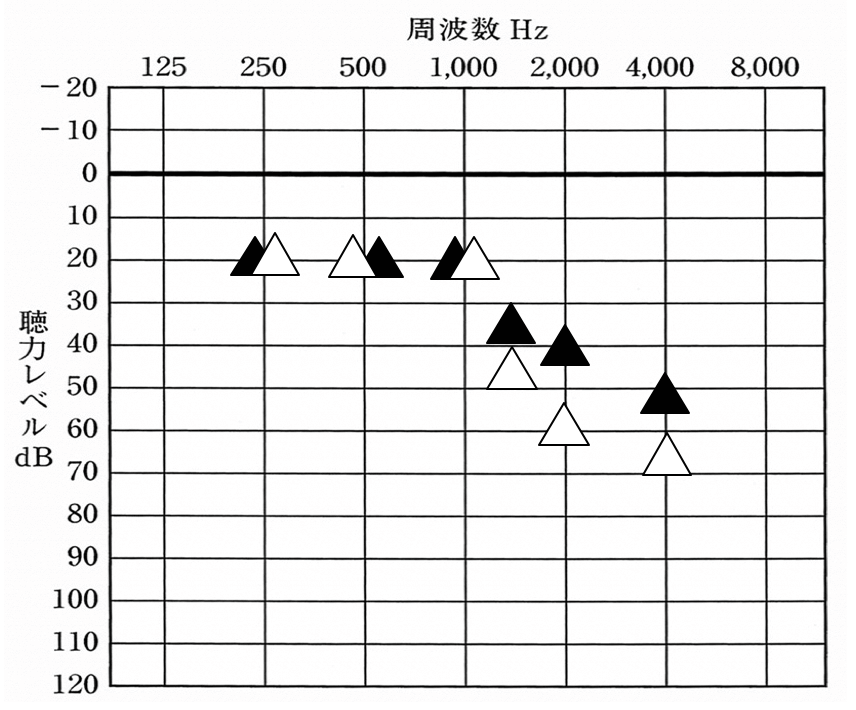 補聴器の世界には、補聴器を装用した状態でどのくらい聞こえるのかを調べる道具がある。こちらは、その道具を使用して調べた数値。