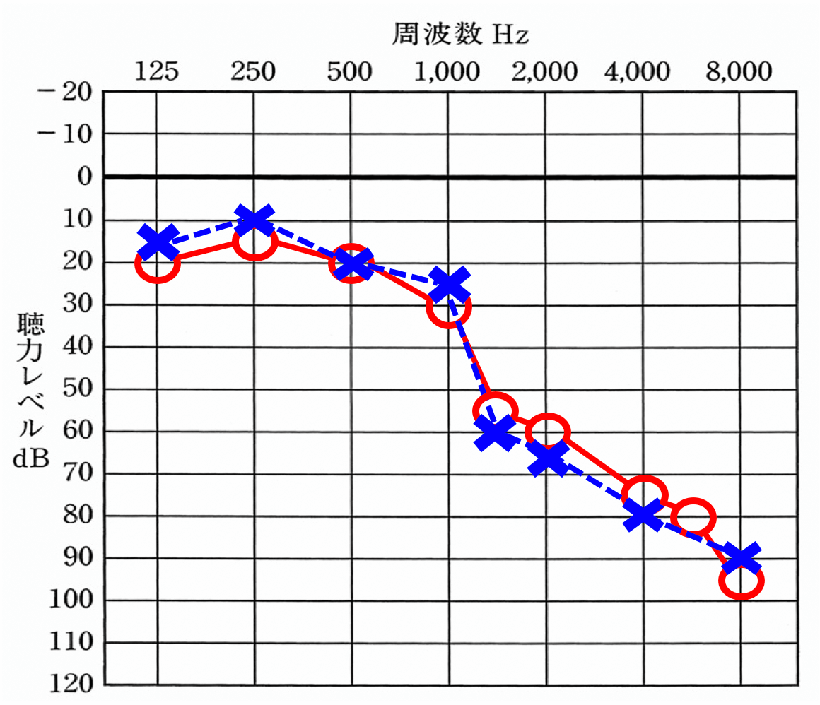 高音急墜形の聴力。高い音から急に聞きにくくなり、特定の音や騒がしい中での聞き取りが難しくなる。