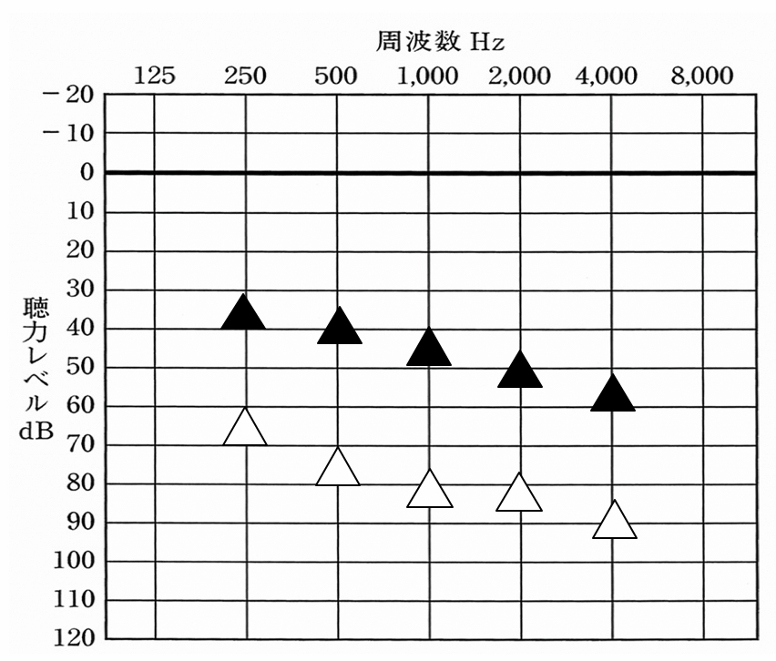 高度難聴の場合の改善例。聴力低下が大きくなれば、それだけ欲しい数値までは、改善しにくくなる。特に30〜40dBの間まで改善させるのは、高度の場合、困難である。