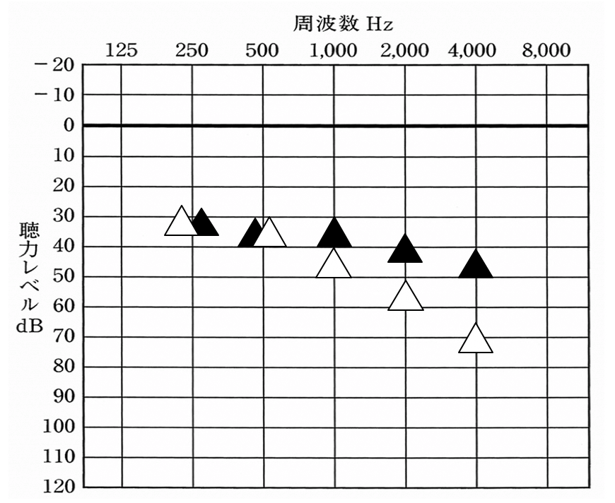軽度の方で多く見られる聴力の改善例。補聴器で効果を出すには、大抵30〜40dBの間まで改善させること。軽度であれば、それがやりやすい。