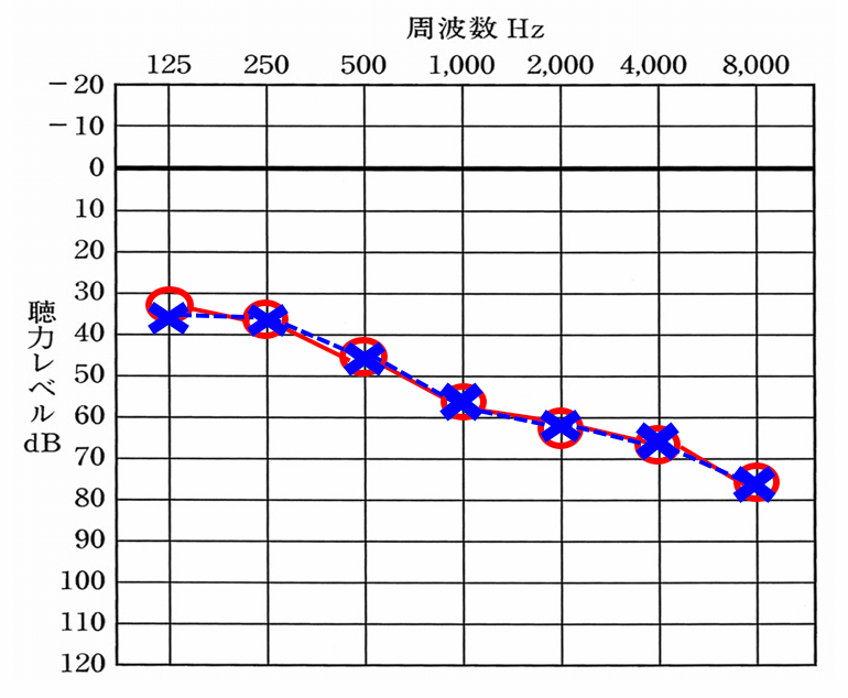 ケースその1、両耳の聴力が同じくらいのケースの例。